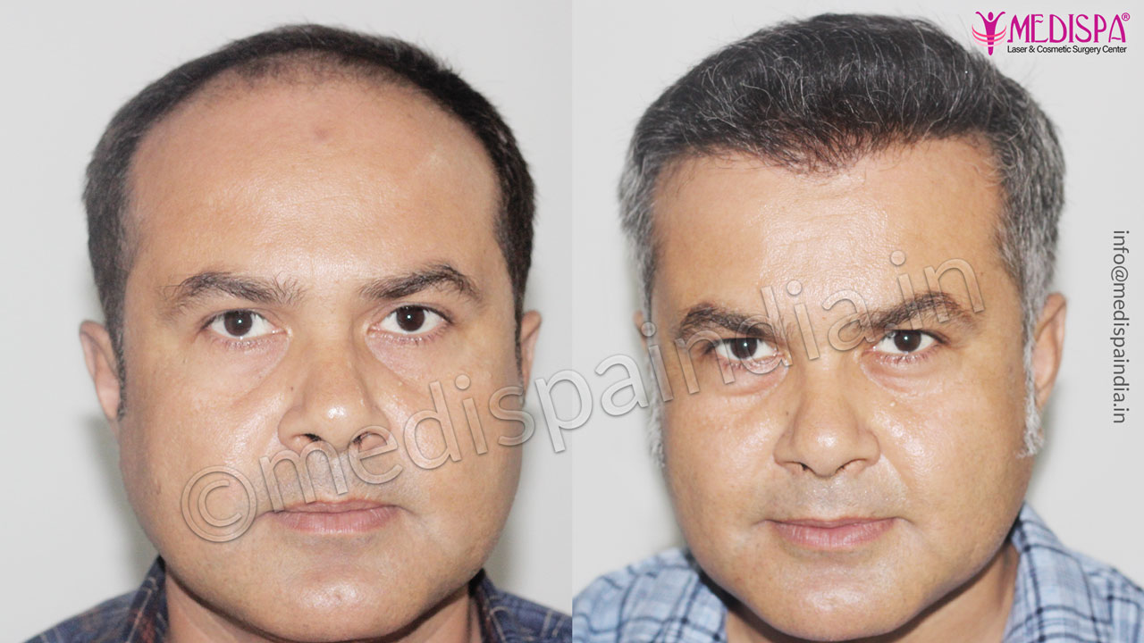 Hair Transplant Before After Result – Photo Gallery Hair Transplant in Delhi | Hair Transplant Cost in Delhi Clinic Hair Transplant Before After Result – Photo Gallery Hair Transplant in Delhi | Hair Transplant Cost in Delhi Clinic