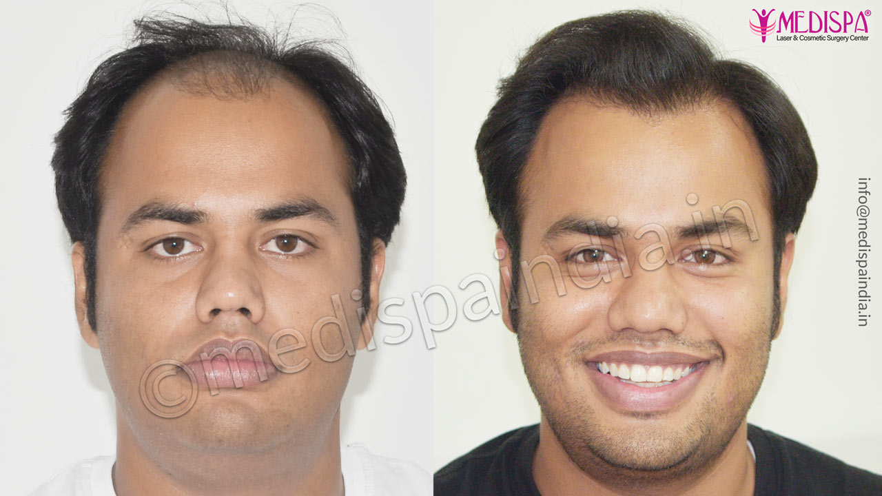 dubai hair transplant result