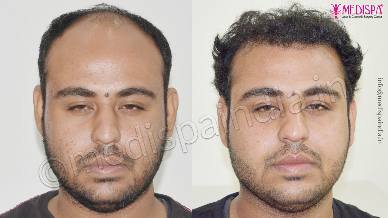 hair transplant cost in dubai