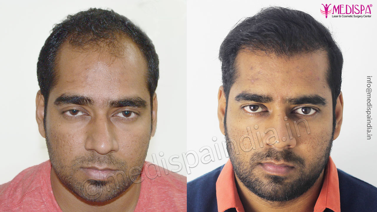 cost of hair transplant india