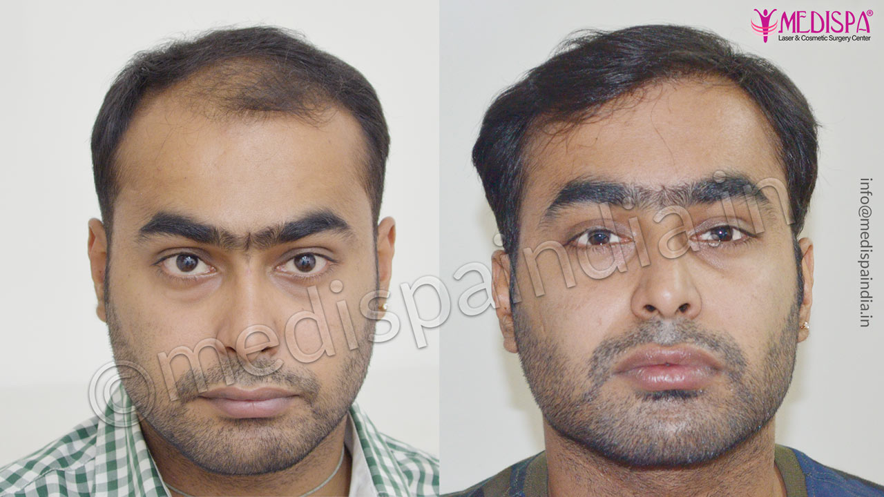 dubai hair transplant result