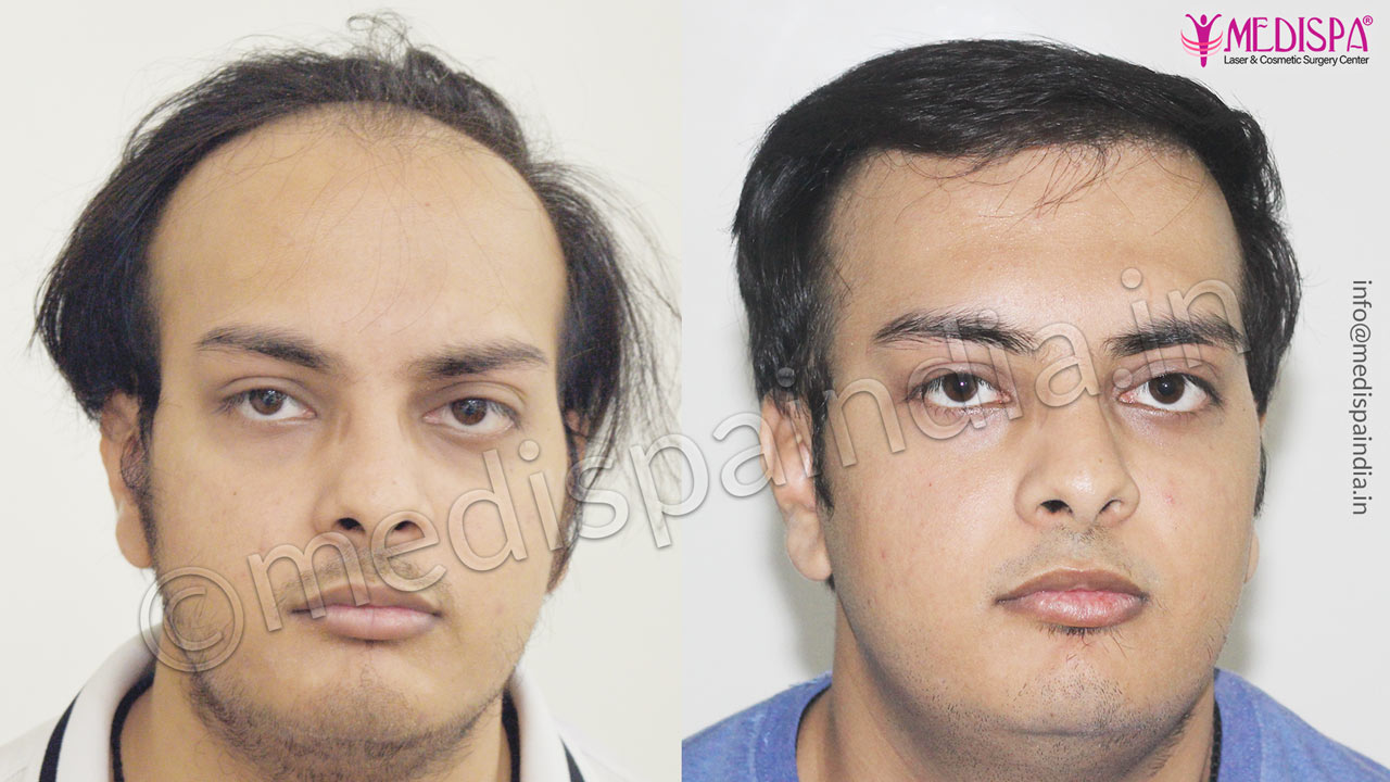 hair restoration cost india