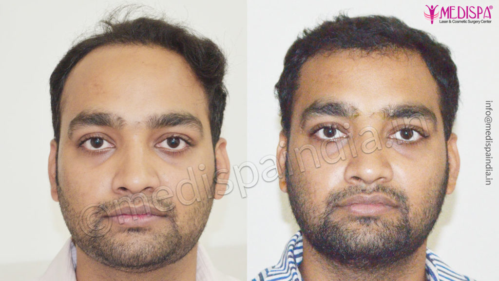 Best Hair Transplant Surgeons in Kolkata - Medispa India Best Hair Transplant Surgeons in Kolkata - Medispa India