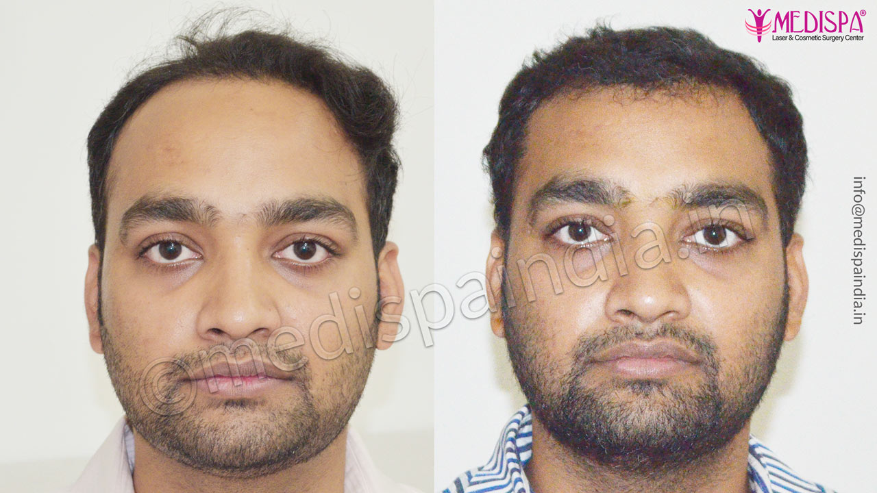 delhi hair transplant cost