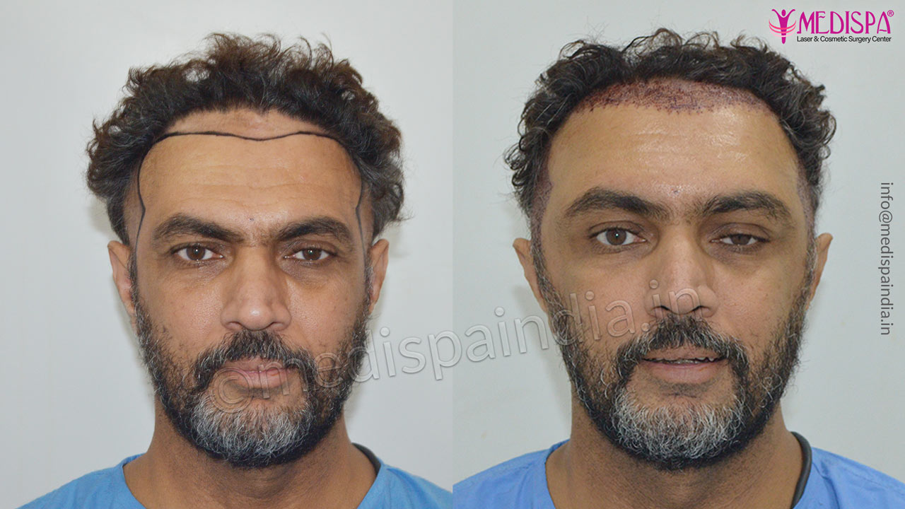 hair transplant in malaysia