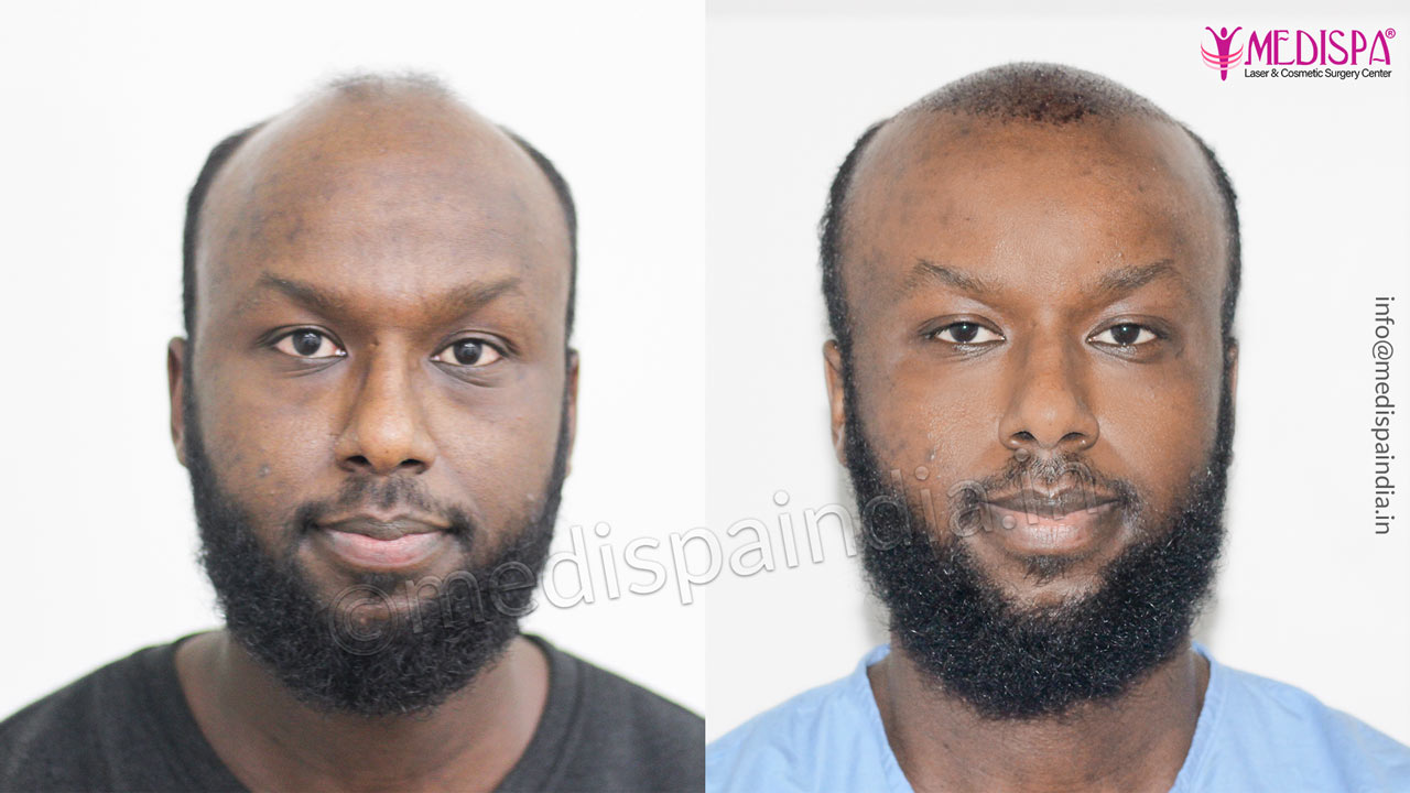 hair transplant sweden results