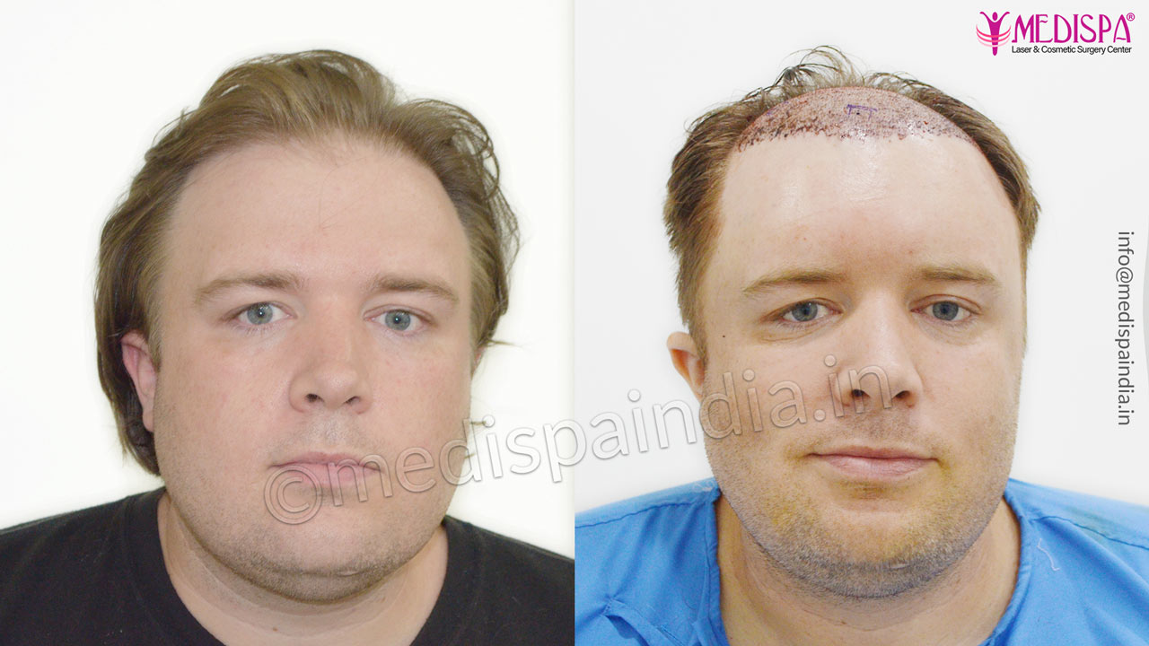 hair transplant usa results