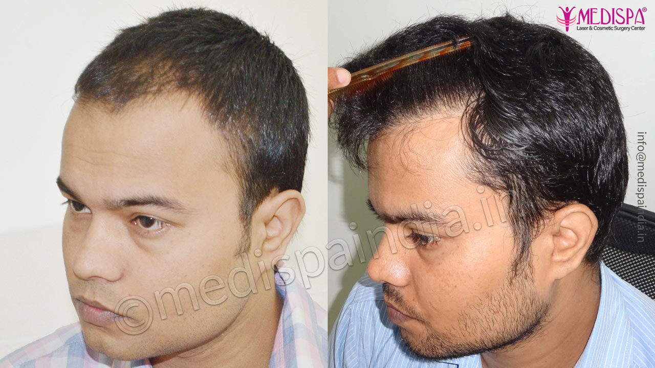 hair transplant cost in india