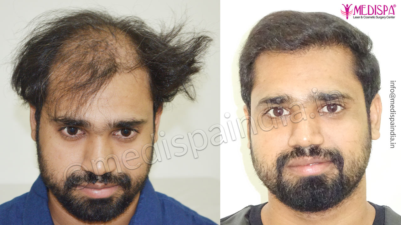 hair transplant cost in dubai