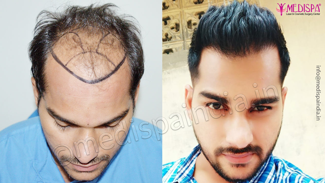 hair transplant cost in india