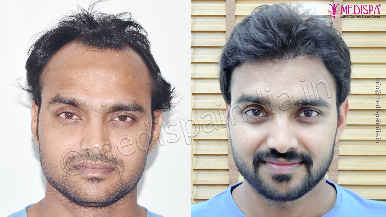 celebrity hair transplant result 