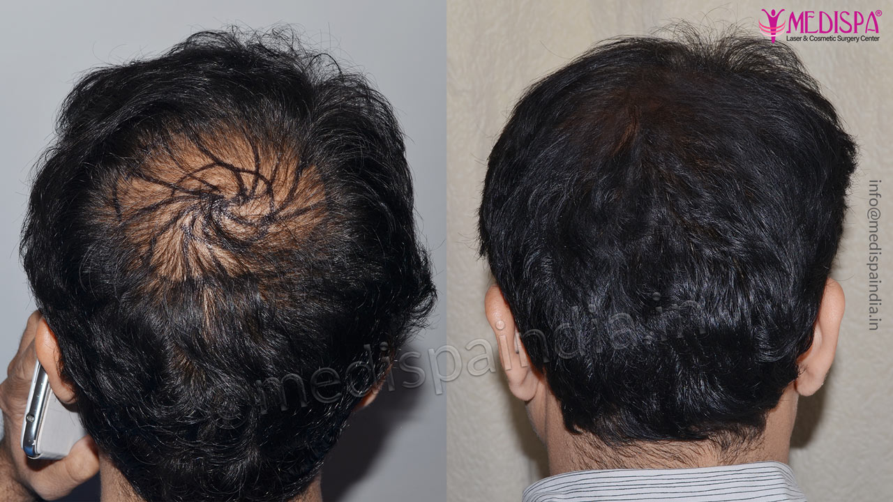 vertex hair transplant results india