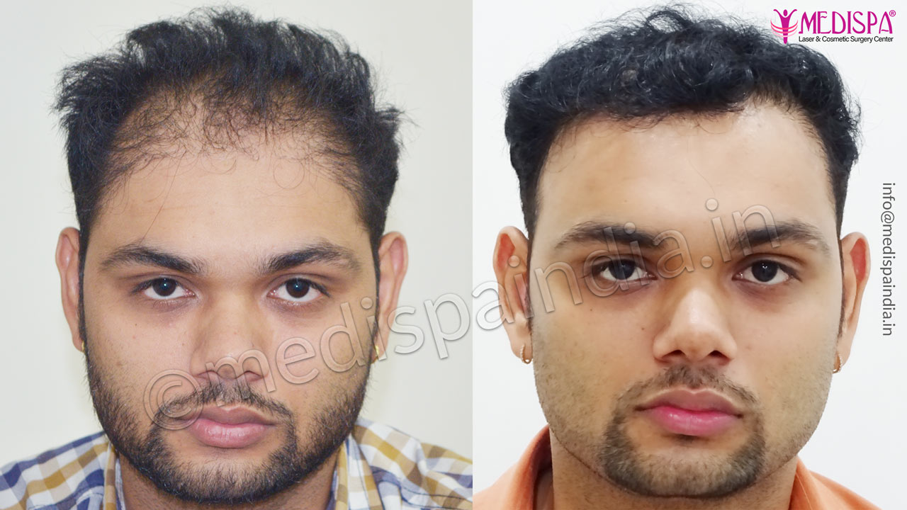 wrong hair transplant correction indore