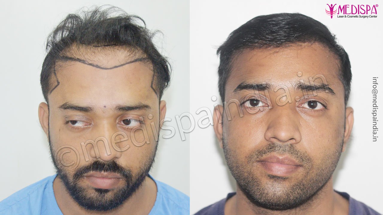 hair transplant cost in dubai