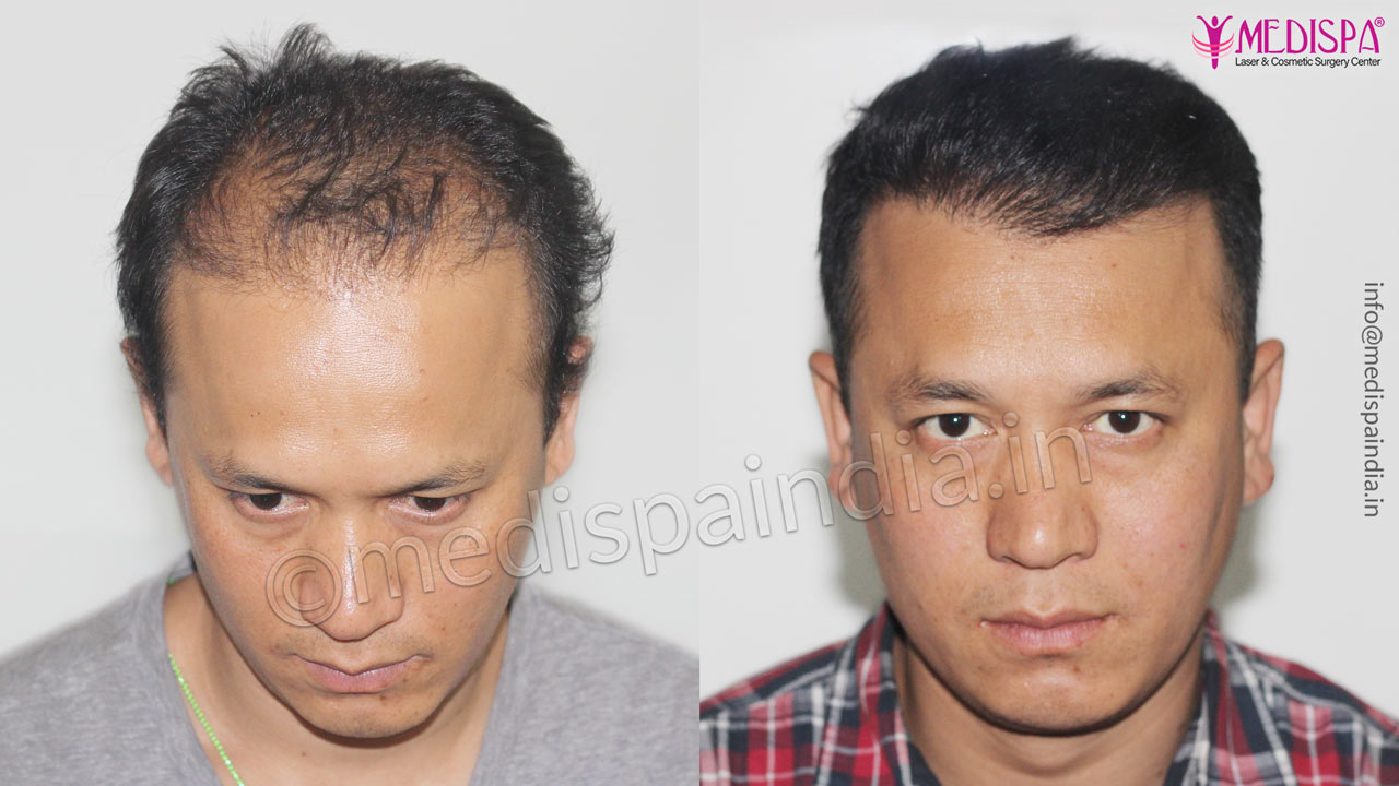 best hair transplant results in jaipur