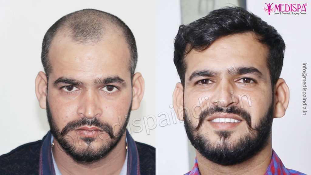 Hair Transplant in Gurgaon, Best Cost, Expert Surgeon Hair Transplant in Gurgaon, Best Cost, Expert Surgeon