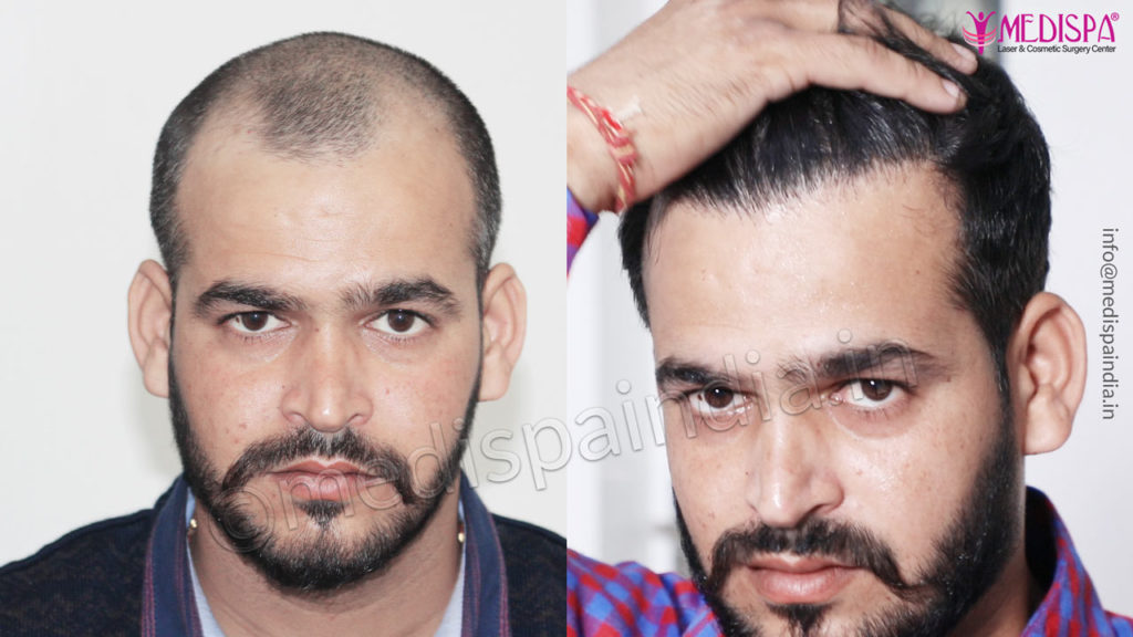 Hair Graft Calculator | Hair Transplant Cost | Medispa India Hair Graft Calculator | Hair Transplant Cost | Medispa India