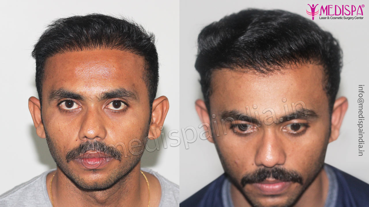 Wrong Bad Hair Transplant Correction Photo Gallery Hair Transplant in Delhi | Hair Transplant Cost in Delhi Clinic Wrong Bad Hair Transplant Correction Photo Gallery Hair Transplant in Delhi | Hair Transplant Cost in Delhi Clinic