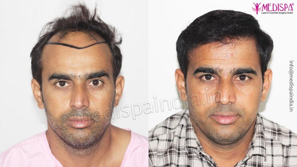 Best Hair Transplant in Mumbai, Expert Surgeon & Best Cost Best Hair Transplant in Mumbai, Expert Surgeon & Best Cost