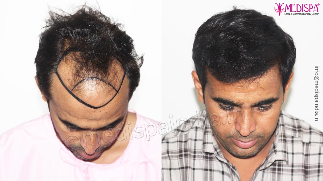 What is a Bio-FUT/ Strip Hair Transplant Procedure What is a Bio-FUT/ Strip Hair Transplant Procedure