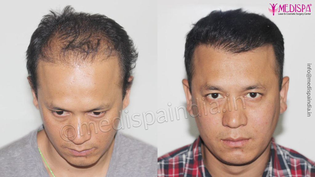 Hair Transplant in Chennai, Best Surgeon, Cost & Clinic Hair Transplant in Chennai, Best Surgeon, Cost & Clinic