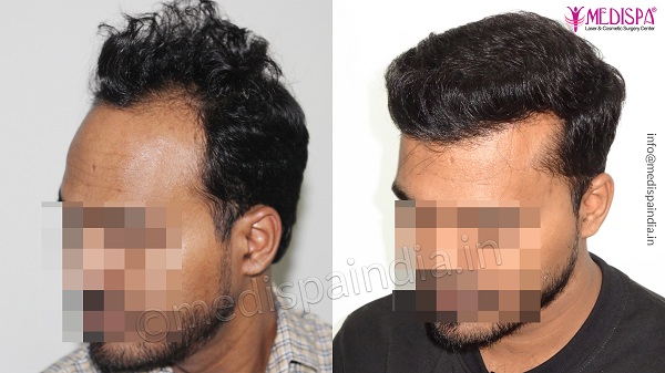 Elaborate The Entire Hair Transplant Process Elaborate The Entire Hair Transplant Process