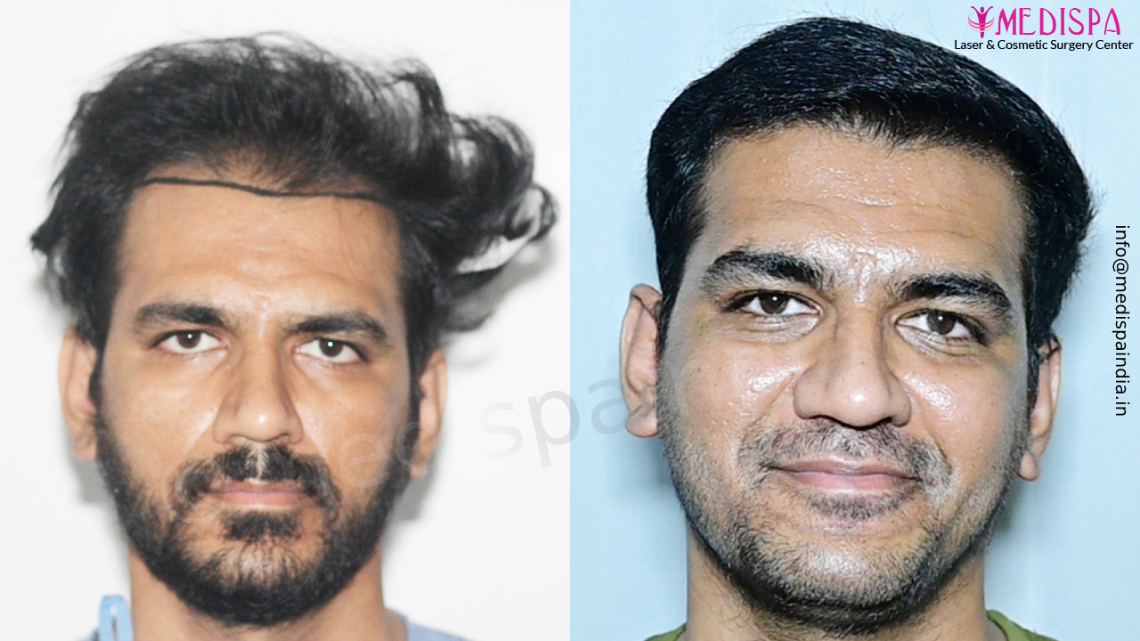 hair transplant jaipur cost