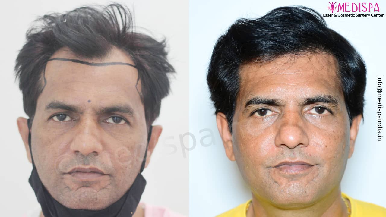 hair transplant in Jaipur