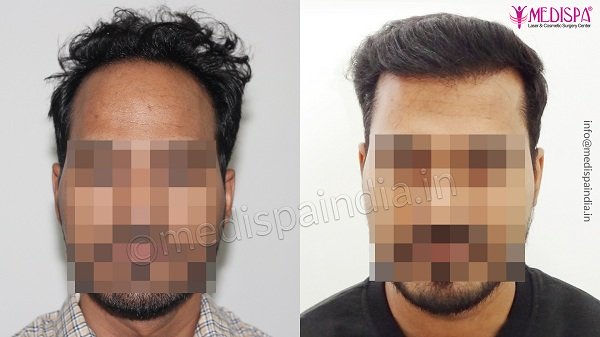 Best Hair Transplant Clinic in Mysore | Medispa Best Hair Transplant Clinic in Mysore | Medispa