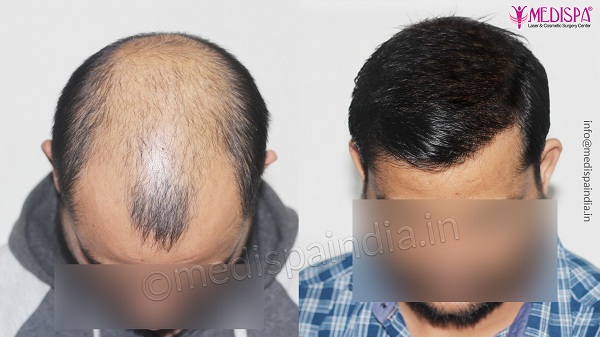 Hair Transplant in Thrissur | Hair Transplant Cost in Thrissur Hair Transplant in Thrissur | Hair Transplant Cost in Thrissur