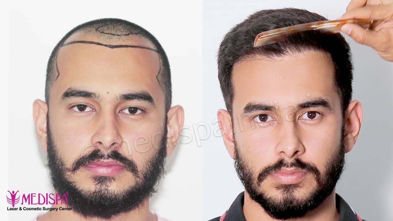 Jaipur hair transplant