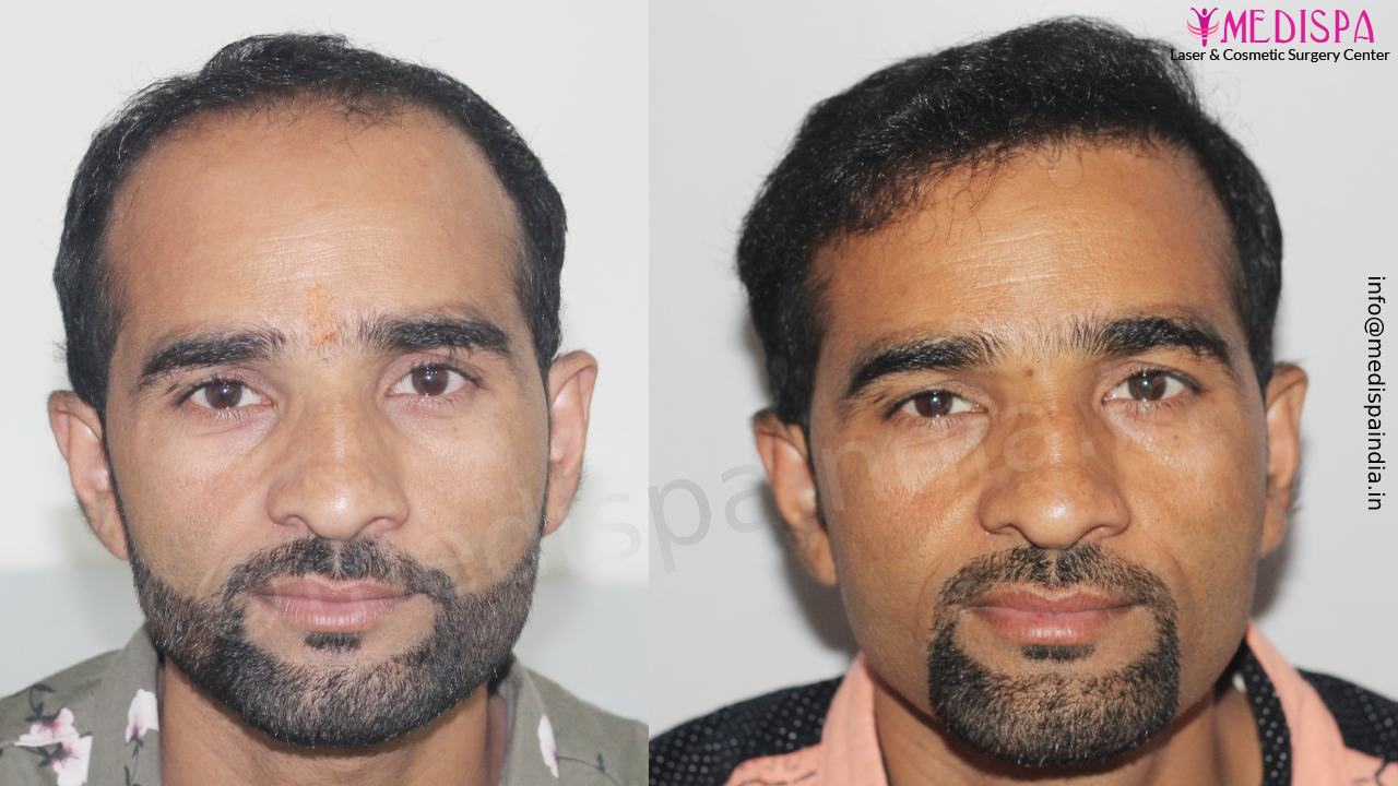 hair transplant in india