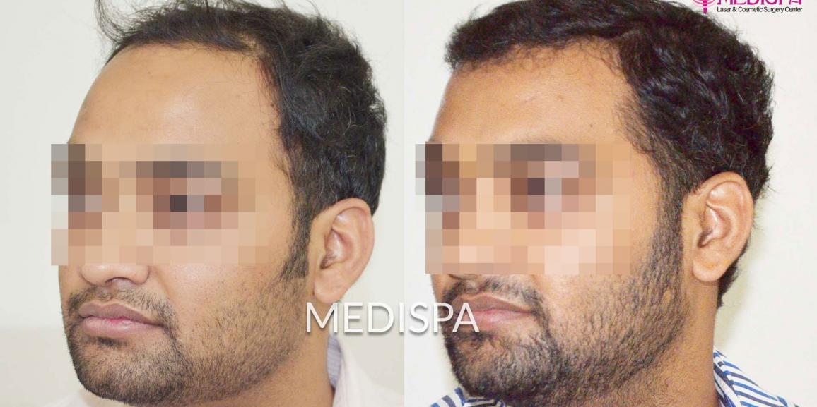 What Is The Right Age To Get Hair Transplant Treatment?