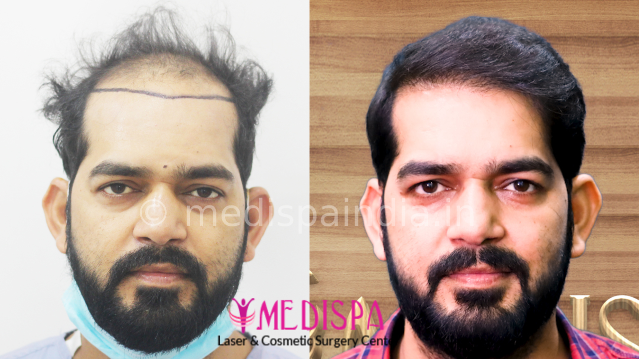 hair transplant india