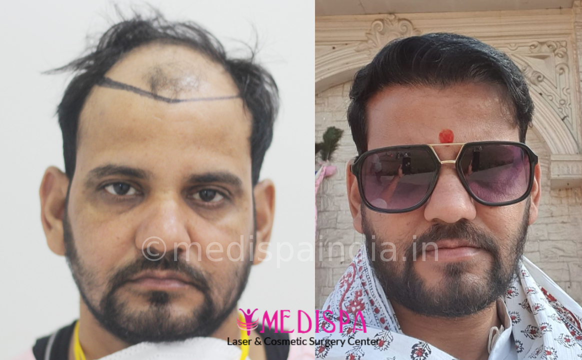 hair transplant result in india