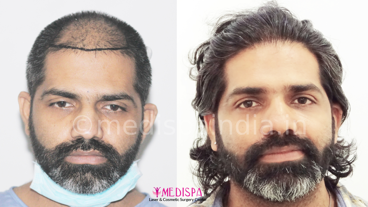 hair transplant result in india