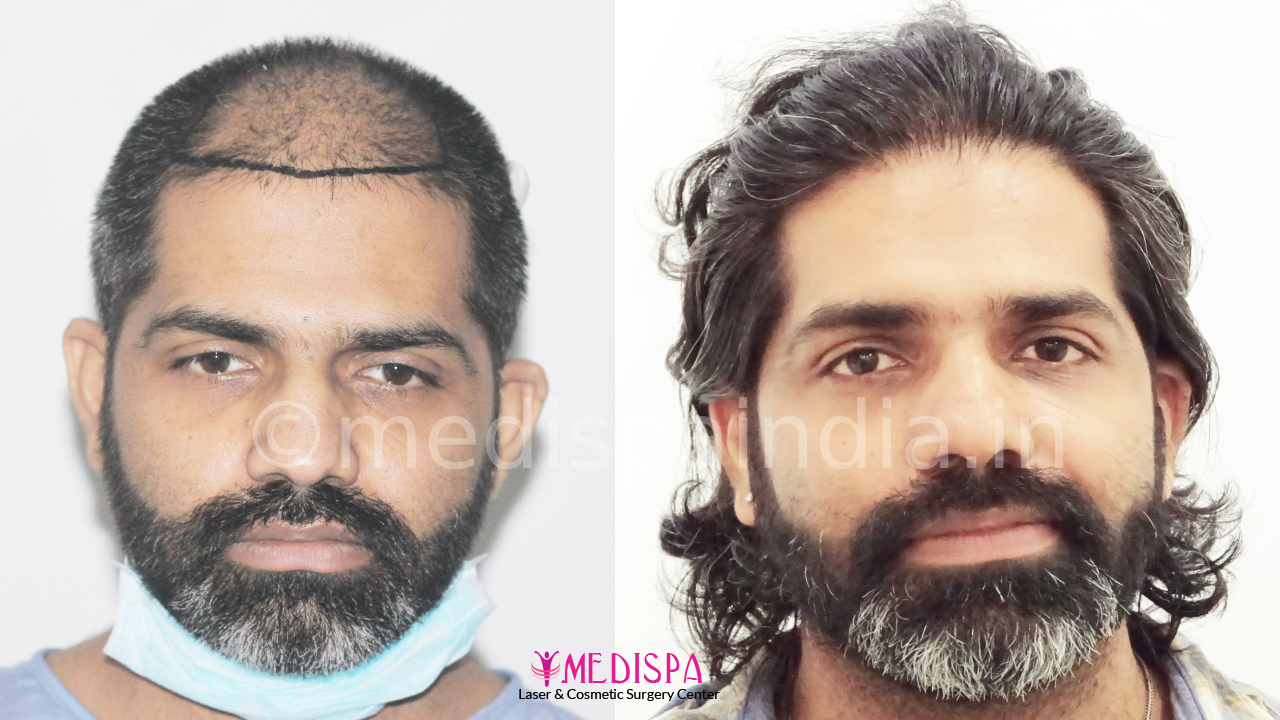 Male Hair Transplant Photo Gallery Hair Transplant in Delhi | Hair Transplant Cost in Delhi Clinic Male Hair Transplant Photo Gallery Hair Transplant in Delhi | Hair Transplant Cost in Delhi Clinic