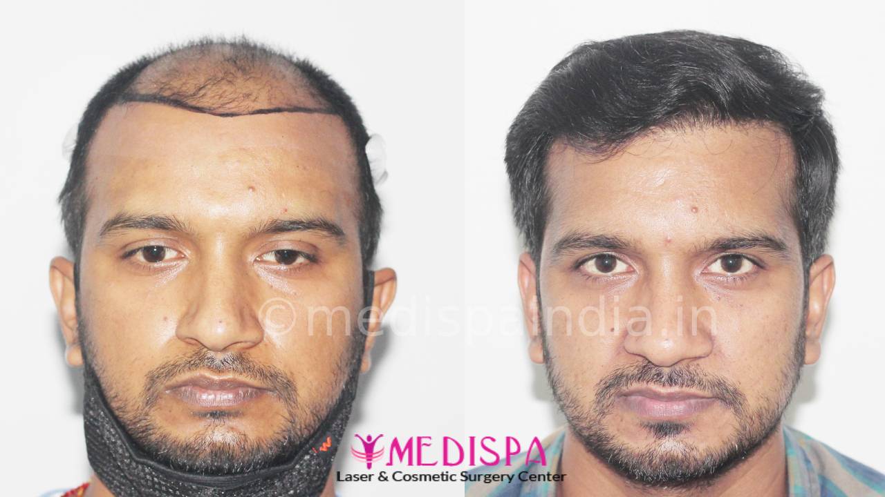 hair transplant cost in india