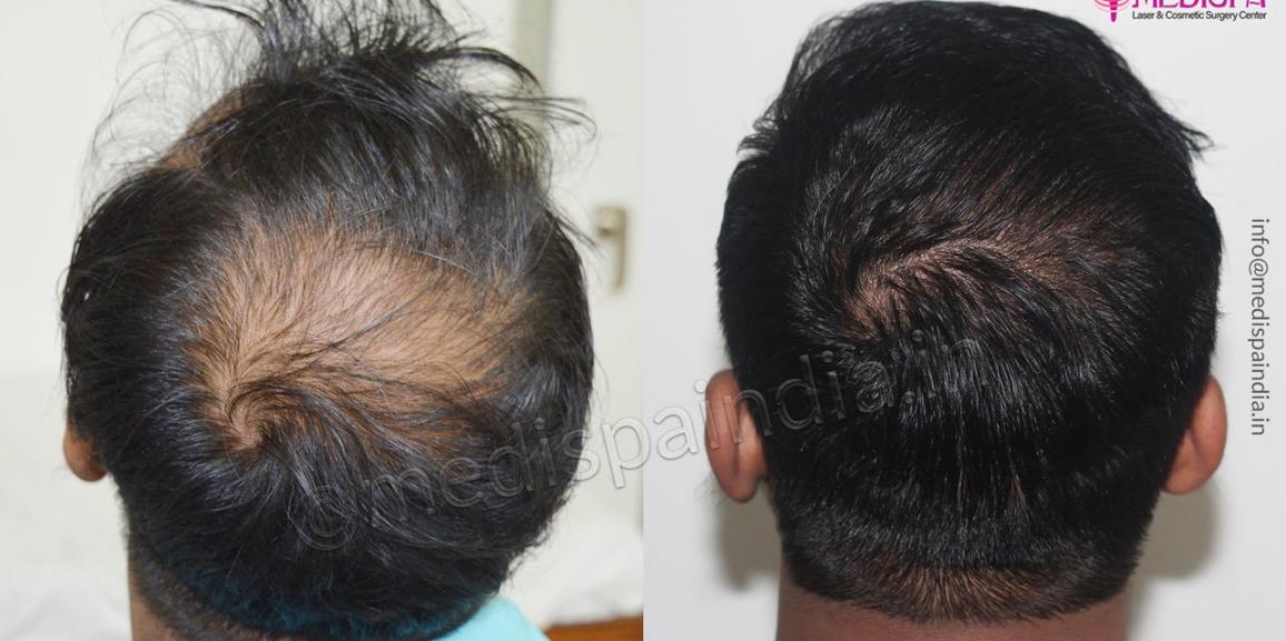Explain The Stages of Baldness And How Hair Transplant Can Help? Explain The Stages of Baldness And How Hair Transplant Can Help?
