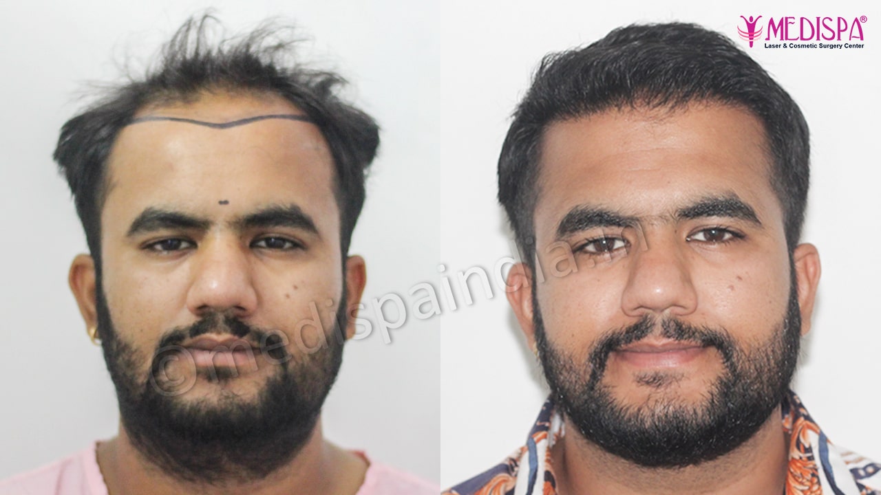 hair transplant in Jaipur
