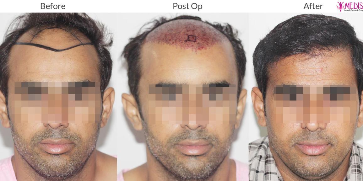 Why Hair Transplant Is Considered A Safe Procedure For Everyone